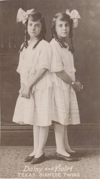 Рабство, богатство и неудачные браки: как сложилась жизнь сиамских близнецов Сиамские близнецы Дейзи и Вайолет Хилтон родились в начале XX века в Великобритании. Они родились сросшимися в